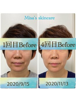 ミサズ スキンケア(misa's skin care)/ビフォー/ビフォー 40代