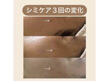 リフィール(Re:feel)/シミケア【ビフォーアフター】