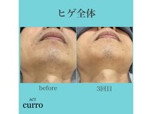 アクト クロ(ACT curro)/【ヒゲ全体】脱毛施術例