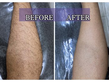 ルブレ Ginza5店(RUBURE)/【足脱毛ビフォアフター】