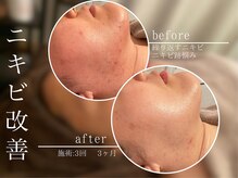ビジュープラス 水戸店(Bijou+)の雰囲気（長い間お悩みの方・繰り返すニキビケアにもおすすめです♪）