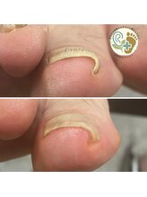 チェンジ(CHANGE)/巻き爪ケアサービス