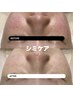 【シミ・目元シワケア】乳歯幹細胞導入+エアバリ+EMSで目元&肌全体ケア◎