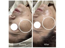 ダリア(Dahlia)/プラピールでシミケア