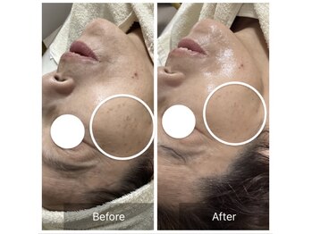 ダリア(Dahlia)/プラピールでシミケア