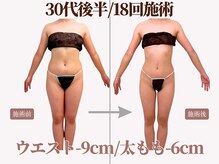 結婚式を控える花嫁様の痩身エステも多く担当させて頂いてます☆