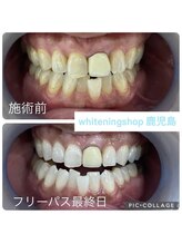 ホワイトニングショップ 鹿児島店/#鹿児島ホワイトニング
