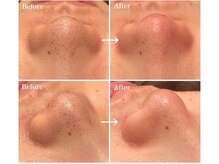 スア(SUA)/ハイドラビフォーアフター