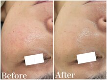 サロンドフェイス(Salon de Faith)/ハーブピーリング