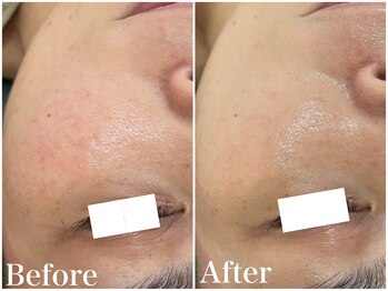 サロンドフェイス(Salon de Faith)/ハーブピーリング