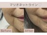 【たるみ改善】リフトアップ機械＆顔/頭/首originalハンド¥22000→