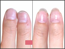 アモ 坂戸(’Amo)/深爪矯正・自爪育成 坂戸/北坂戸