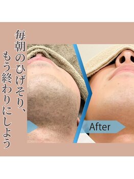 ミル(milu)/青ヒゲとさよなら、清潔感肌へ