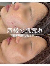 インテリウス(INteRius.)/産後の肌ケア