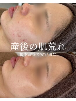 インテリウス(INteRius.)/産後の肌ケア