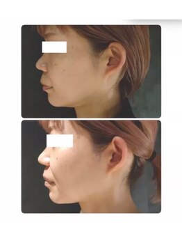 アンシャンテ(Anchant)/レモンボトル２回