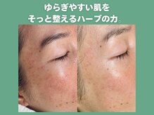 ポノ(Pono)の雰囲気（肌荒れ/ニキビ/赤み/ハリ不足etc..幅広いお悩みにハーブが効く！）