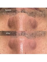 ミホノ 和泉中央店(mihono)/男性 毛穴洗浄