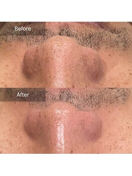 ミホノ 和泉中央店(mihono)/男性 毛穴洗浄