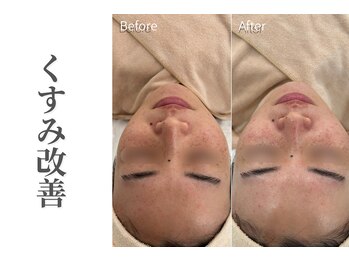 エトレ(etre)/毛穴/くすみ/強炭酸/エステ