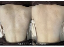 ボディ(背中・二の腕・お尻etc.)のメニューもおすすめです！