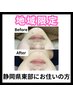 毛穴洗浄×鍼【内も外もお肌を美しく】毛穴洗浄美顔鍼 60分  ¥14,300→