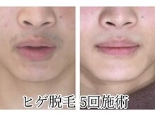 イデアルボーテ/メンズ脱毛メニューもあります