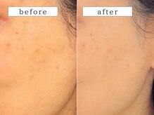 ビューティズムラウンジ(Beautism Lounge)/ミネラルスキンフェイシャル