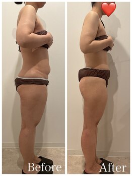 まろん鍼灸接骨院 立川店/痩身エステ（下半身）