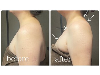 イーストモア(EAST MOIS)/筋膜ケアで首・肩こり解消！！