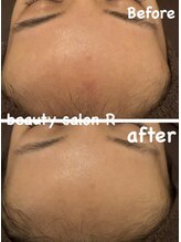 ビューティサロン アール(R)/おでこのお肌トラブルも改善