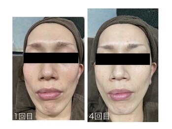 チャマ 高知店(CHAMA)/40代 水光ピール 赤み シミ