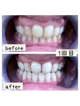 サロン ド スカイ(Salon de sky)/セルフホワイトニング☆