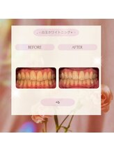 プラスビーセルフ(+b self)/ホワイトニングビフォーアフター