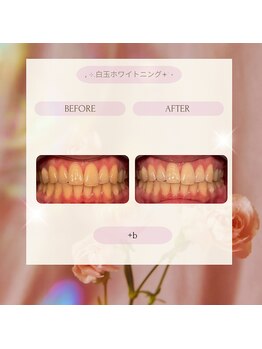 プラスビーセルフ(+b self)/ホワイトニングビフォーアフター