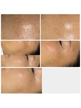 ミュー 新小岩店(Mieux)/セラピール5回効果