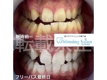 ホワイトニングサロン 福岡天神店/ホワイトニング