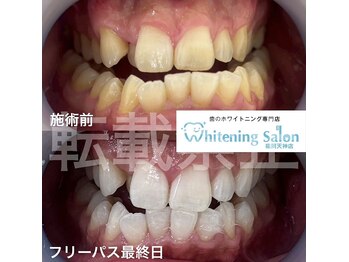 ホワイトニングサロン 福岡天神店/ホワイトニング