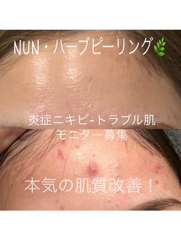 ヌン(NUN.)/ハーブピーリング!