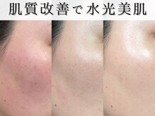 ジョンミー(JONMEE)の雰囲気(韓国最新ダクトピールで毛穴・ニキビケア!銀座一丁目.ニキビケア)
