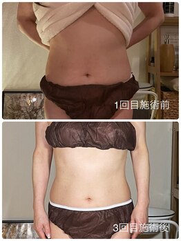 サロン ド サッコ(salon de sacco)/【3回終了後】ビフォーアフター