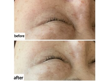 メナードフェイシャルサロン 岐阜茜部/コラックスケアパック