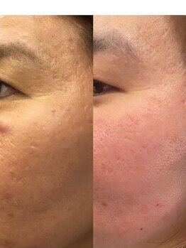 長寿鍼灸院 長寿整骨院/美容鍼50本の効果★トーンアップ