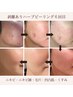 【極上美肌】ハードハーブピーリング・毛穴洗浄24,500円→9,800円