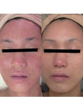 ホワイトアクア 天王寺本店(WHITE AQUA)/ララピール/大阪/天王寺/毛穴