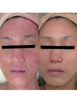 ホワイトアクア 天王寺本店(WHITE AQUA)/ララピール/大阪/天王寺/毛穴