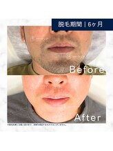 メンズクリア 宇都宮店/【メンズクリア】お客様の施術例