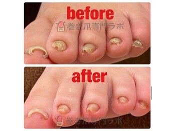 巻き爪専門ラボ 豊田店/爪切り/ケア