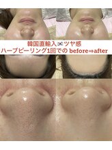 ファミリーセルフサロン 輪(Wa)/韓国直輸入ツヤハーブピーリング