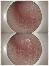 メナードフェイシャルサロン 片町店/毛穴のお掃除